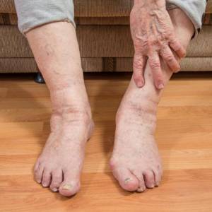 Чому виникають набряки при захворюваннях серцево-судинної системи