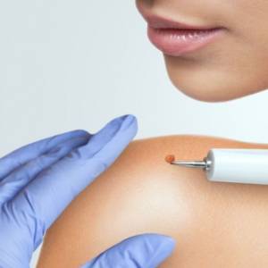 Як позбутись папілом?