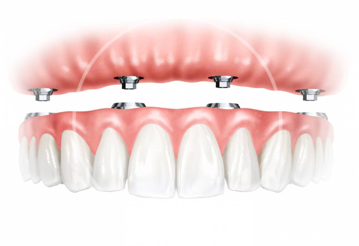 Протезування зубів в Івано-Франківську: як повернути посмішку