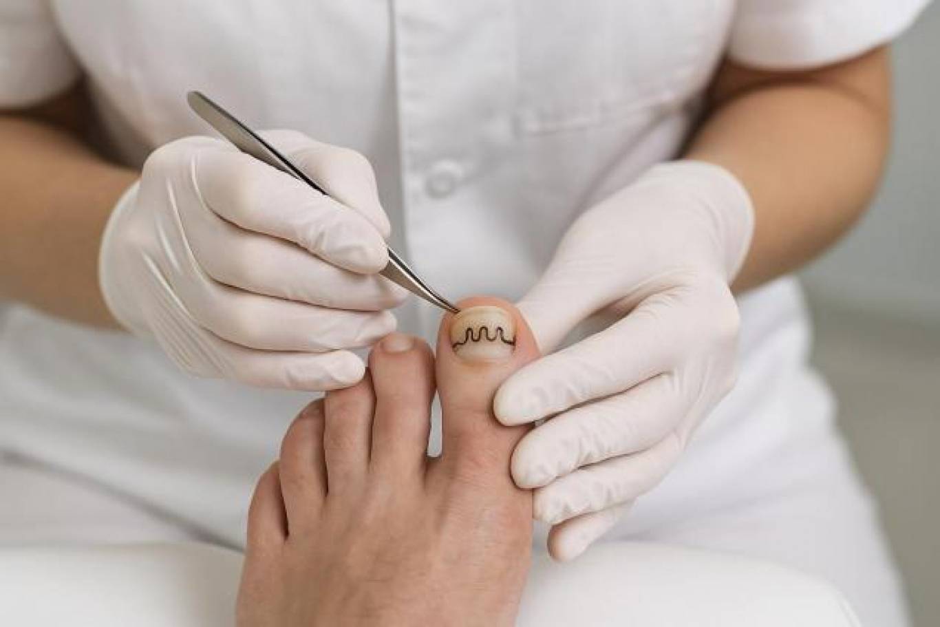 Що таке ортоніксия і як Baehr допомагає в лікуванні нігтьових патологій