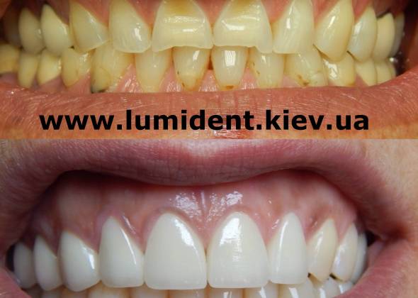 Вініри на передні зуби: все, що ви хотіли про них дізнатися