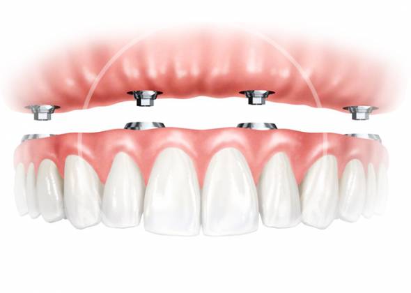 Протезування зубів в Івано-Франківську: як повернути посмішку