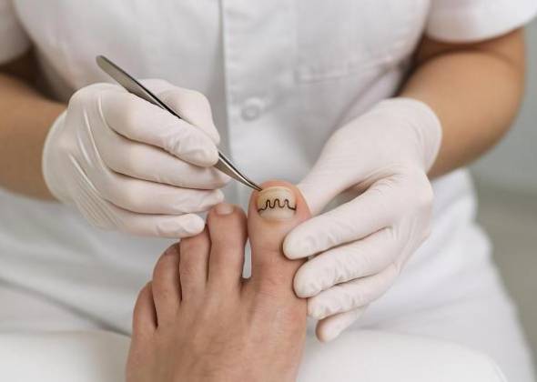 Що таке ортоніксия і як Baehr допомагає в лікуванні нігтьових патологій