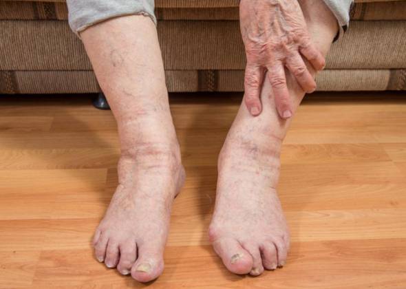 Чому виникають набряки при захворюваннях серцево-судинної системи