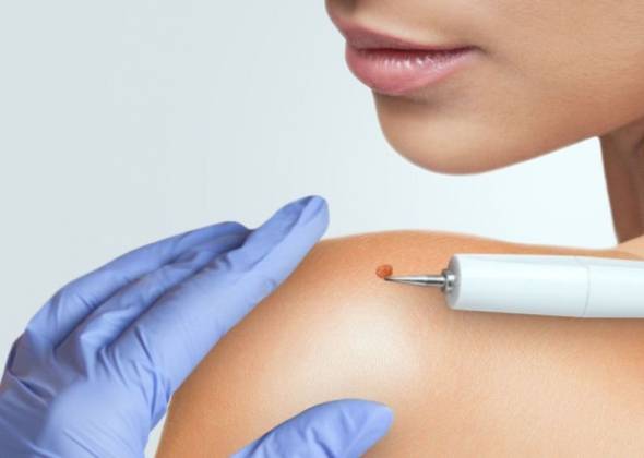 Як позбутись папілом?