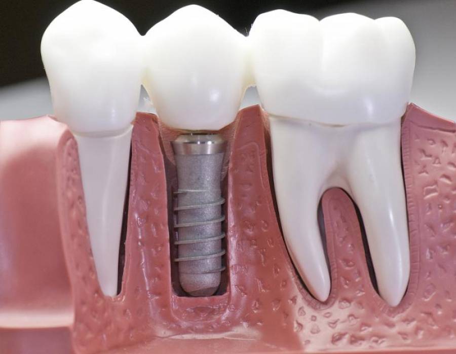 Зубні імпланти: види, підготовка до встановлення