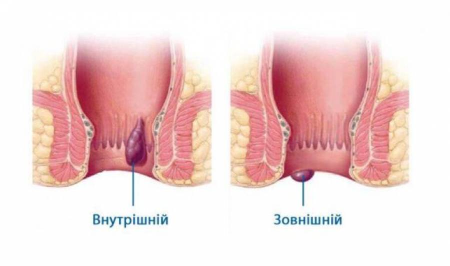 Чому виникає геморой і як уникнути ускладнень?