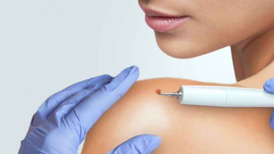 Як позбутись папілом?