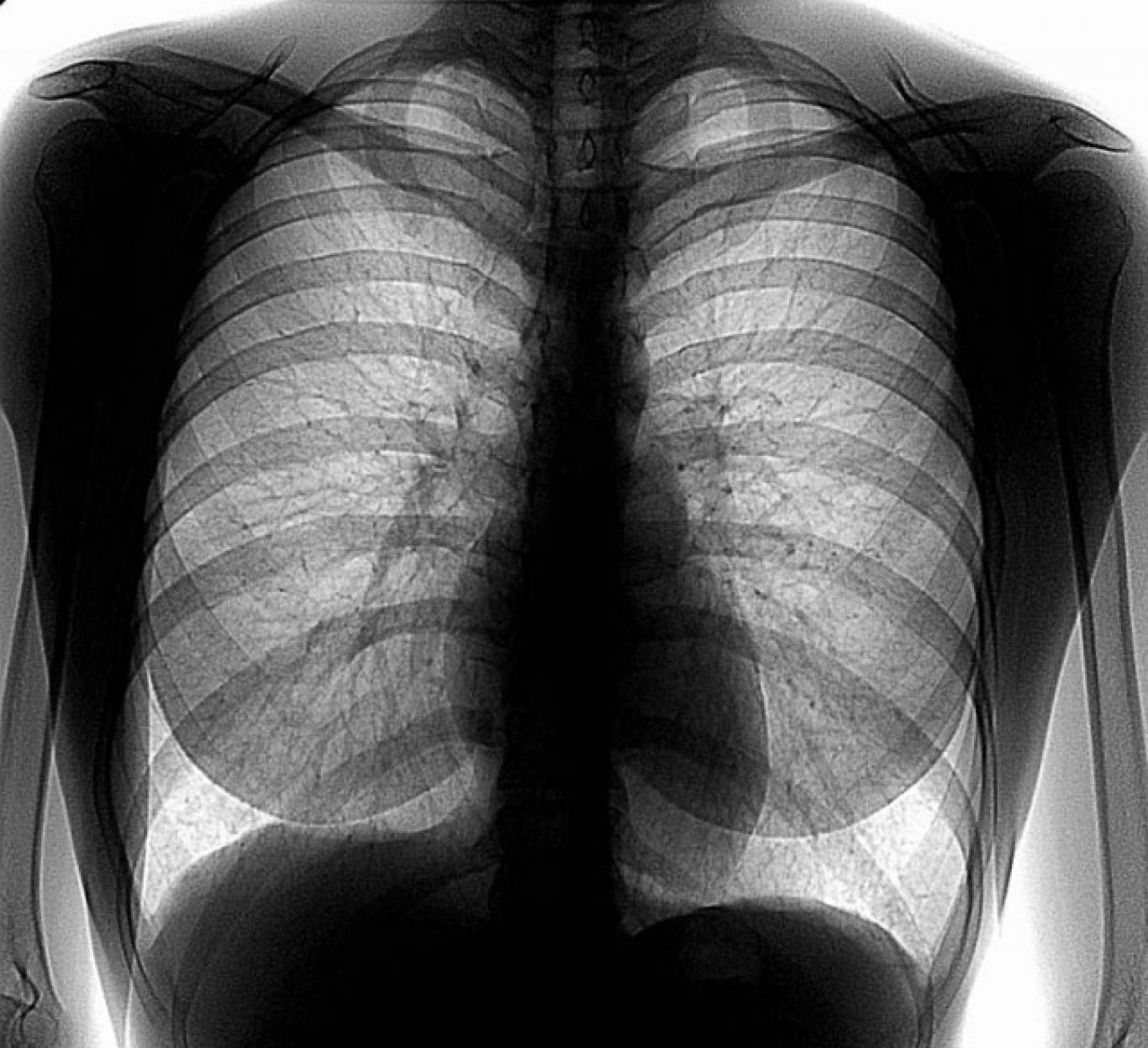 Флюорография легких. Флюорография органов грудной клетки. Цифровая рентгенограмма легких. Снимок флюорографии.