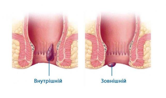 💙 💙 Лазерне видалення гемороя в обласній лікарні Запоріжжя 💙 💙 Вигідні  ціни на видалення гемороя лазером