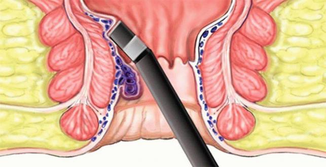 Лікування геморою в Києві, ціна операції по видаленню гемороїдальних вузлів  | Medcity